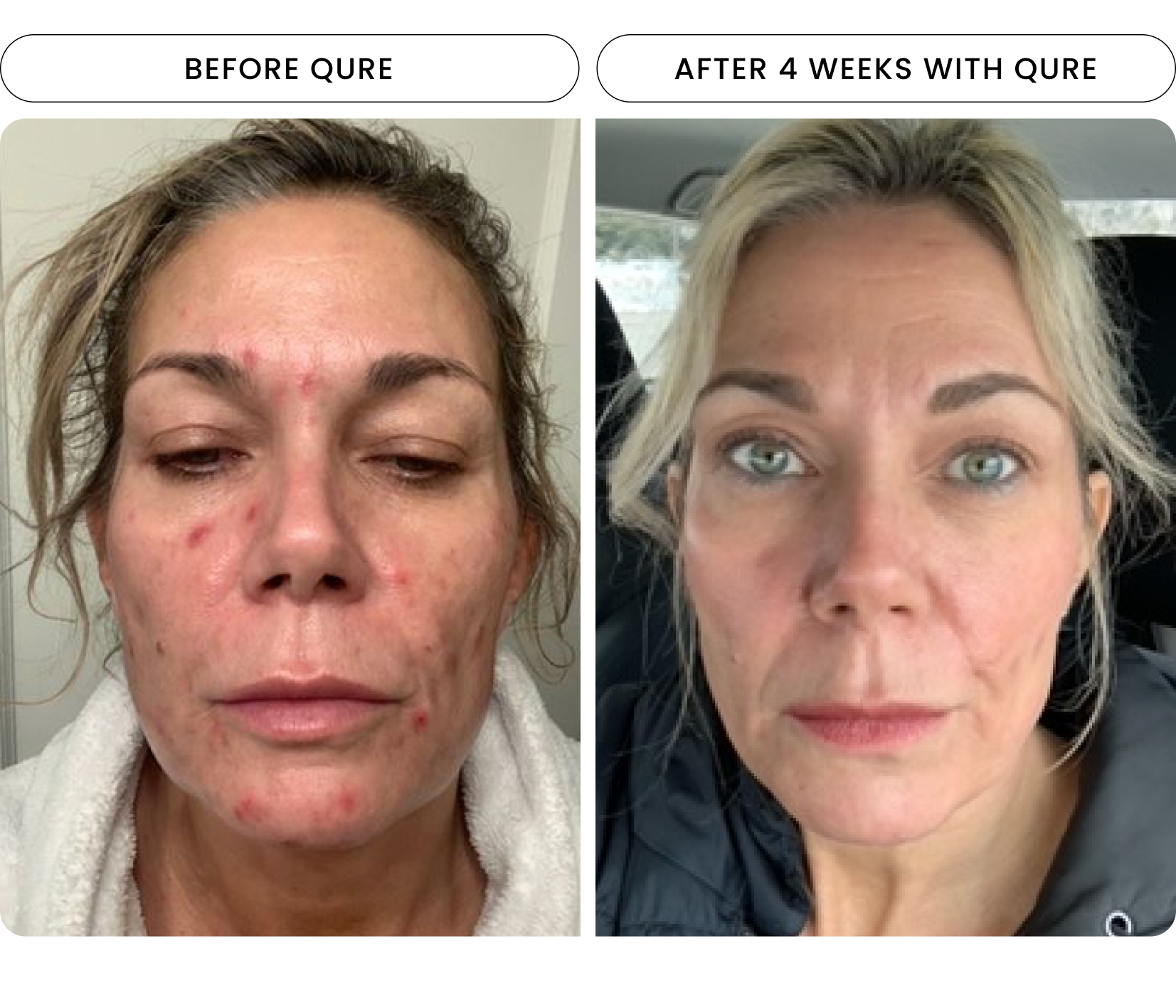 Led Light Therapy Mask Before And After Shelly Lighting Led Light Therapy Mask Before And After Shelly Lighting